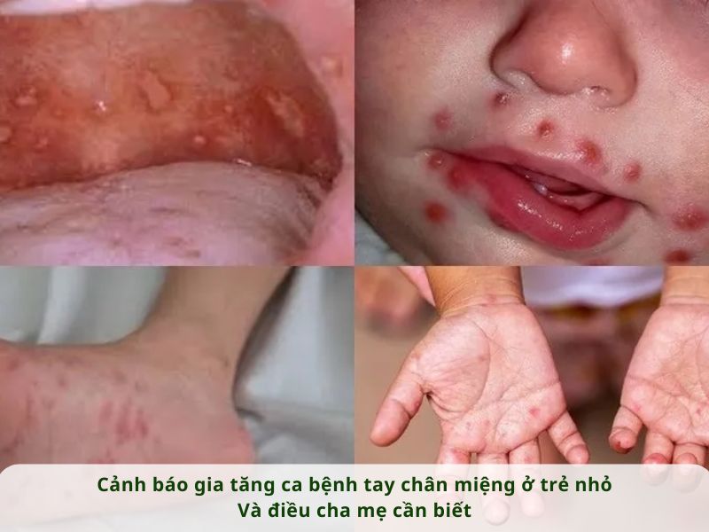 CẢNH BÁO GIA TĂNG CA BỆNH TAY CHÂN MIỆNG Ở TRẺ NHỎ VÀ ĐIỀU CHA MẸ CẦN BIẾT