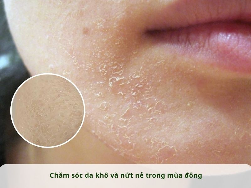 CHĂM SÓC DA KHÔ VÀ NỨT NẺ TRONG MÙA ĐÔNG