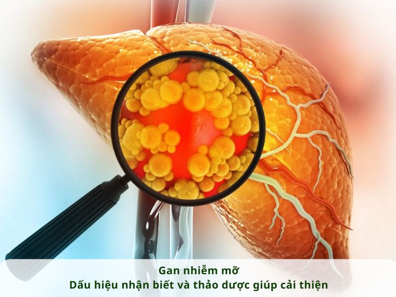 GAN NHIỄM MỠ - DẤU HIỆU NHẬN BIẾT VÀ THẢO DƯỢC GIÚP CẢI THIỆN