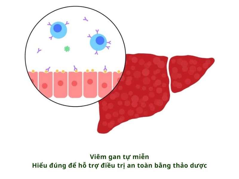 VIÊM GAN TỰ MIỄN - HIỂU ĐÚNG ĐỂ HỖ TRỢ ĐIỀU TRỊ AN TOÀN BẰNG THẢO DƯỢC