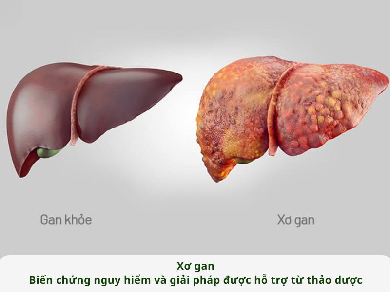 XƠ GAN - BIẾN CHỨNG NGUY HIỂM VÀ GIẢI PHÁP HỖ TRỢ TỪ THẢO DƯỢC